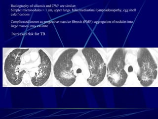 Radiography of silicosis and CWP are similar:
Simple: micronodules < 1 cm, upper lungs, hilar/mediastinal lymphadenopathy, egg shell
calcifications
Complicated known as progessive massive fibrosis (PMF): aggregation of nodules into
large masses, may cavitate
Increased risk for TB
 