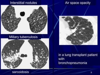 Interstitial nodules Air space opacity
9
Miliary tuberculosis
sarcoidosis
in a lung transplant patient
with
bronchopneumonia
 