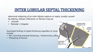 INTER LOBULAR SEPTAL THICKENING
abnormal widening of an inter lobular septum or septa, usually caused
by edema, cellular i...