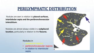 Notice the overlap in differential diagnosis of perilymphatic nodules and the nodular septal
thickening in the reticular p...
