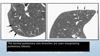 The normal pulmonary vein branches are seen marginating
pulmonary lobules.
The centrilobular artery branches are visible a...