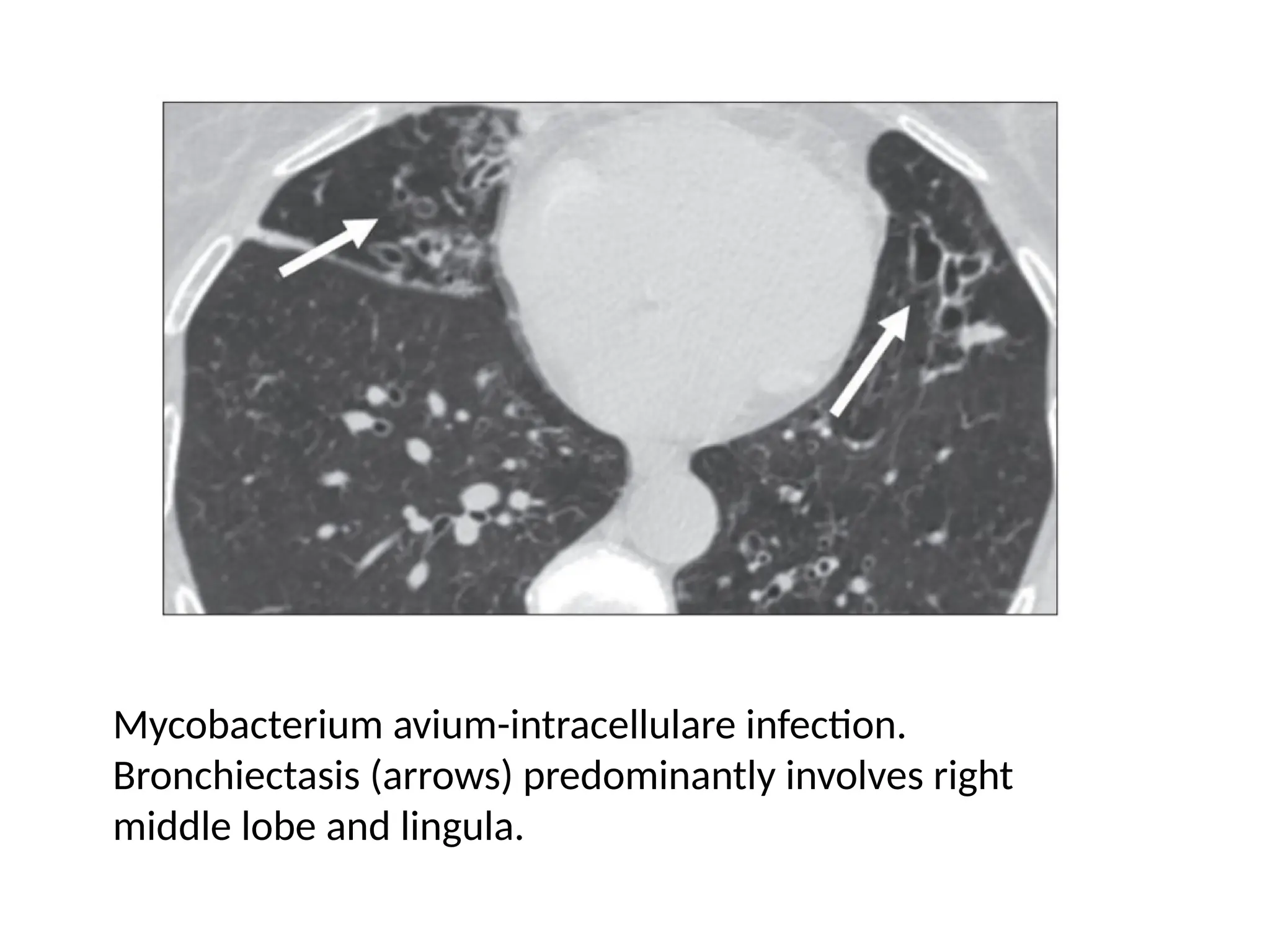 Mycobacterium avium-intracellulare infection.
Bronchiectasis (arrows) predominantly involves right
middle lobe and lingula.
 