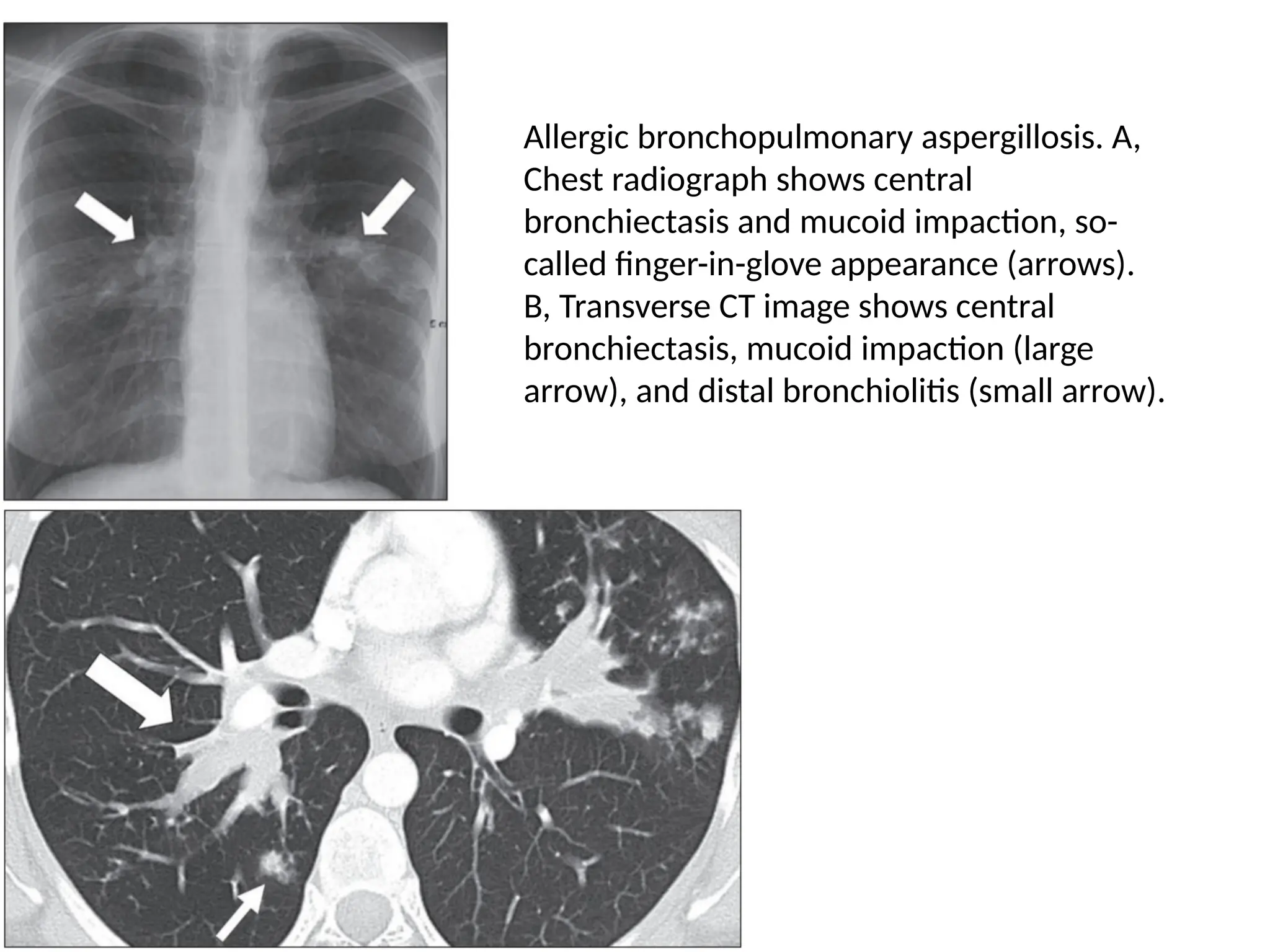 Allergic bronchopulmonary aspergillosis. A,
Chest radiograph shows central
bronchiectasis and mucoid impaction, so-
called finger-in-glove appearance (arrows).
B, Transverse CT image shows central
bronchiectasis, mucoid impaction (large
arrow), and distal bronchiolitis (small arrow).
 
