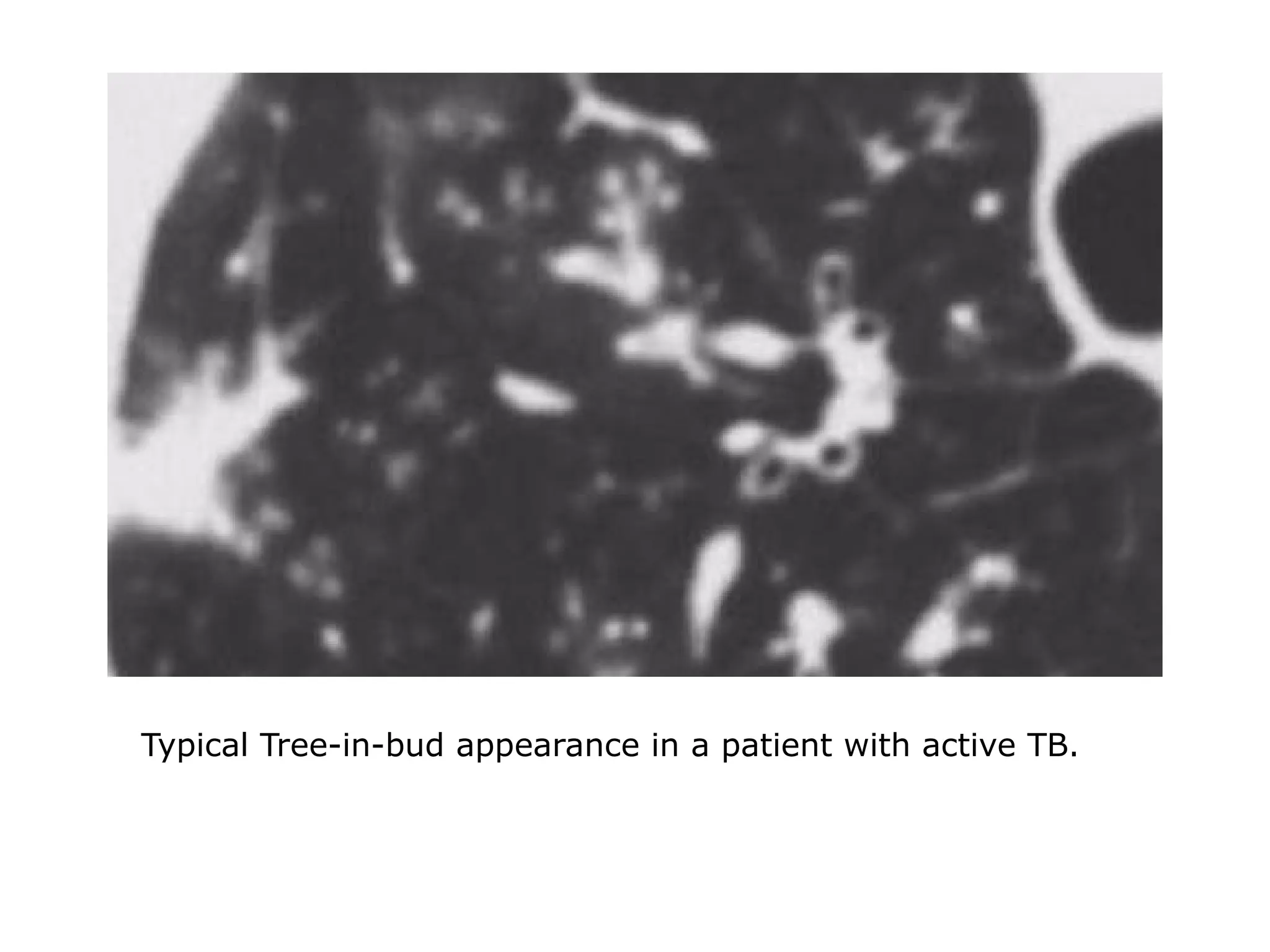 Typical Tree-in-bud appearance in a patient with active TB.
 