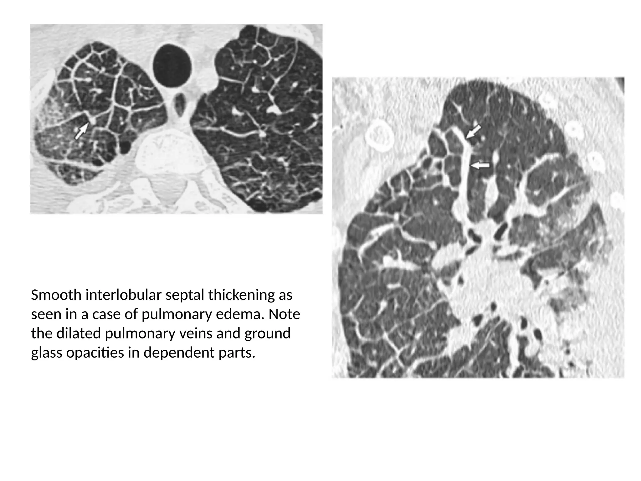 Smooth interlobular septal thickening as
seen in a case of pulmonary edema. Note
the dilated pulmonary veins and ground
glass opacities in dependent parts.
 