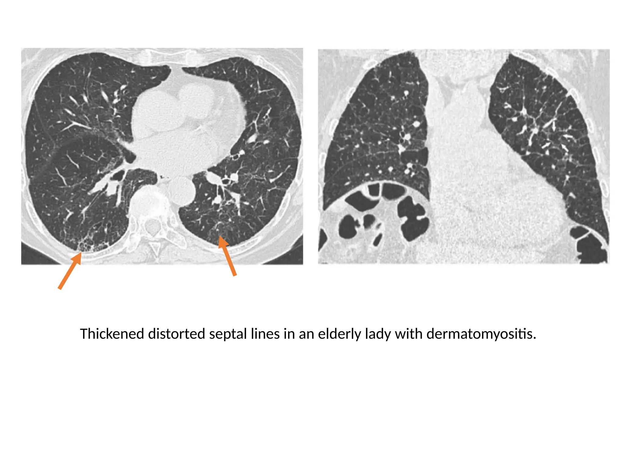 Thickened distorted septal lines in an elderly lady with dermatomyositis.
 