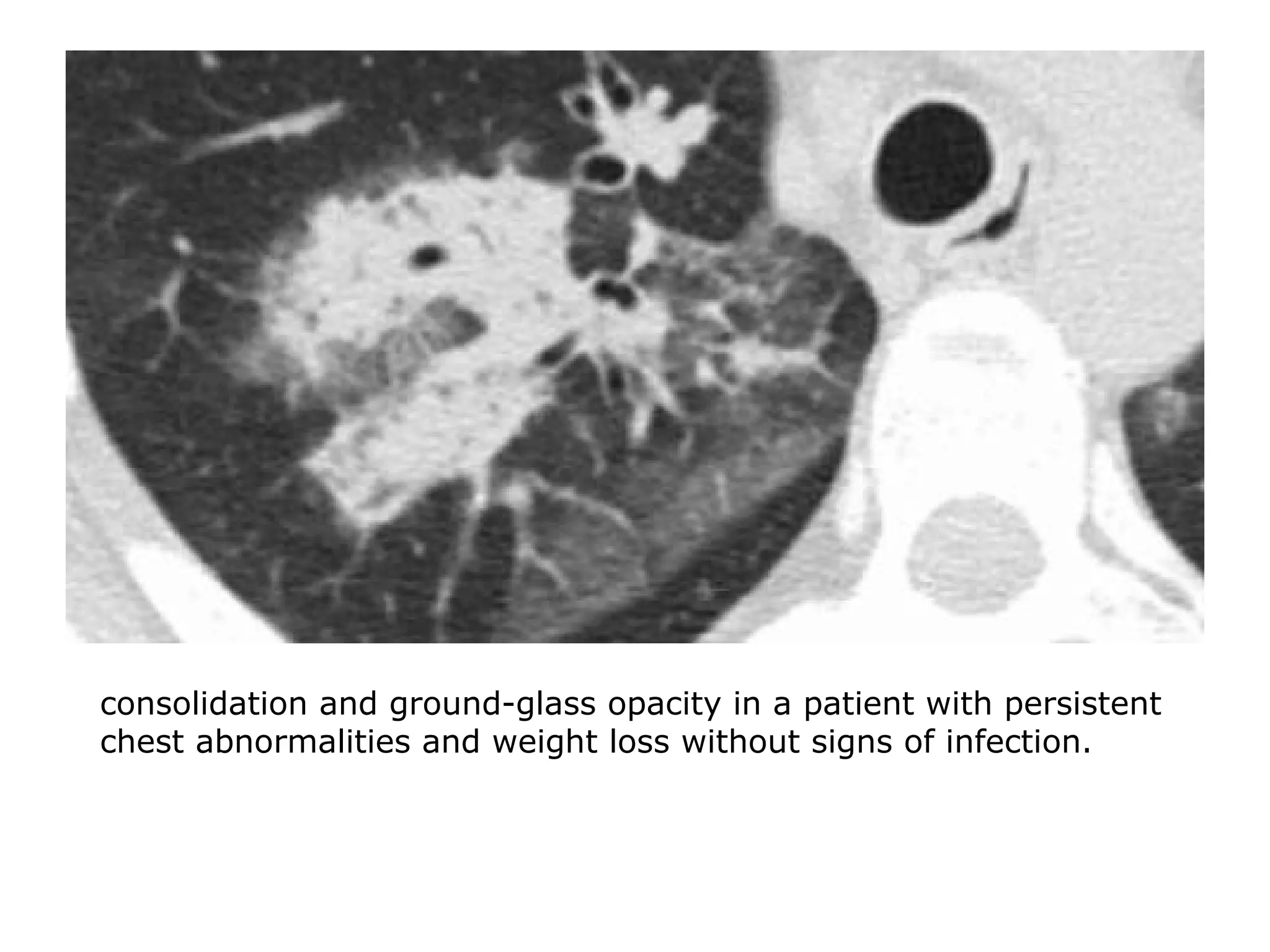 consolidation and ground-glass opacity in a patient with persistent
chest abnormalities and weight loss without signs of infection.
 