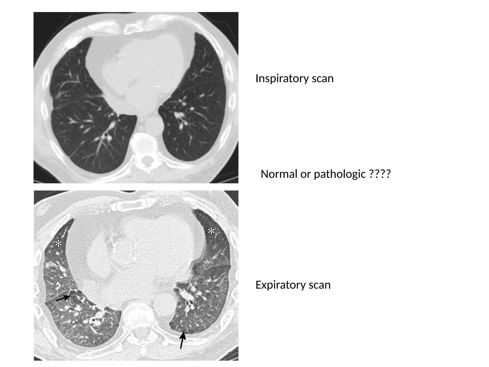 Inspiratory scan
Expiratory scan
Normal or pathologic ????
 