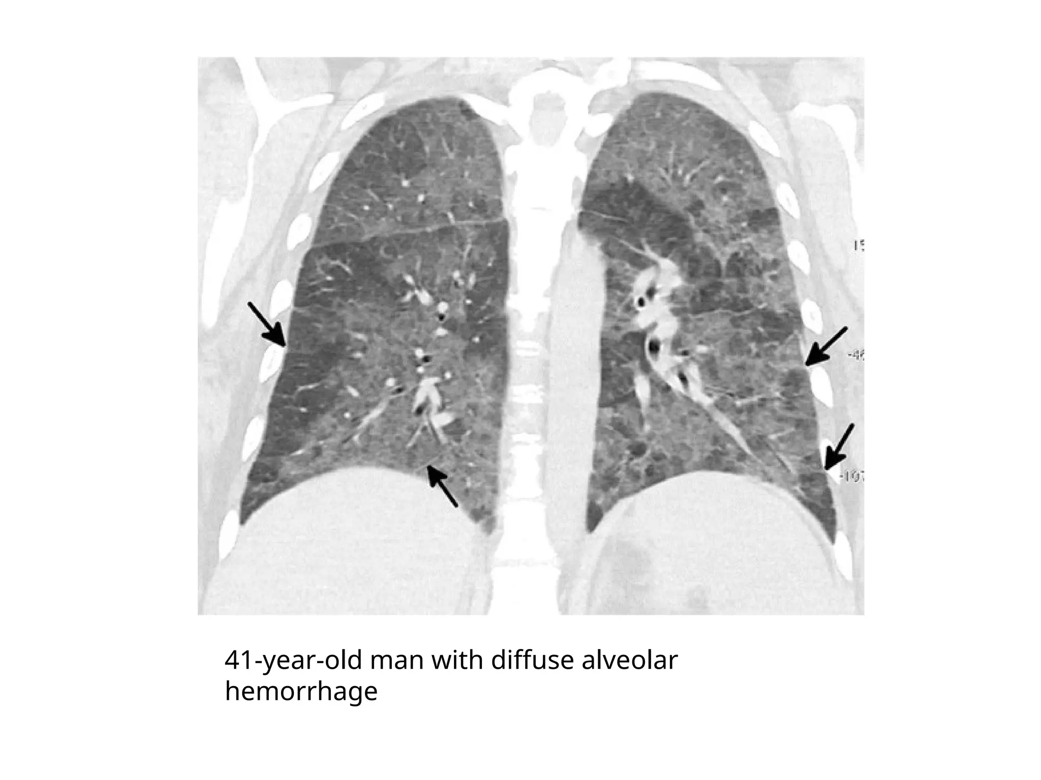 41-year-old man with diffuse alveolar
hemorrhage
 