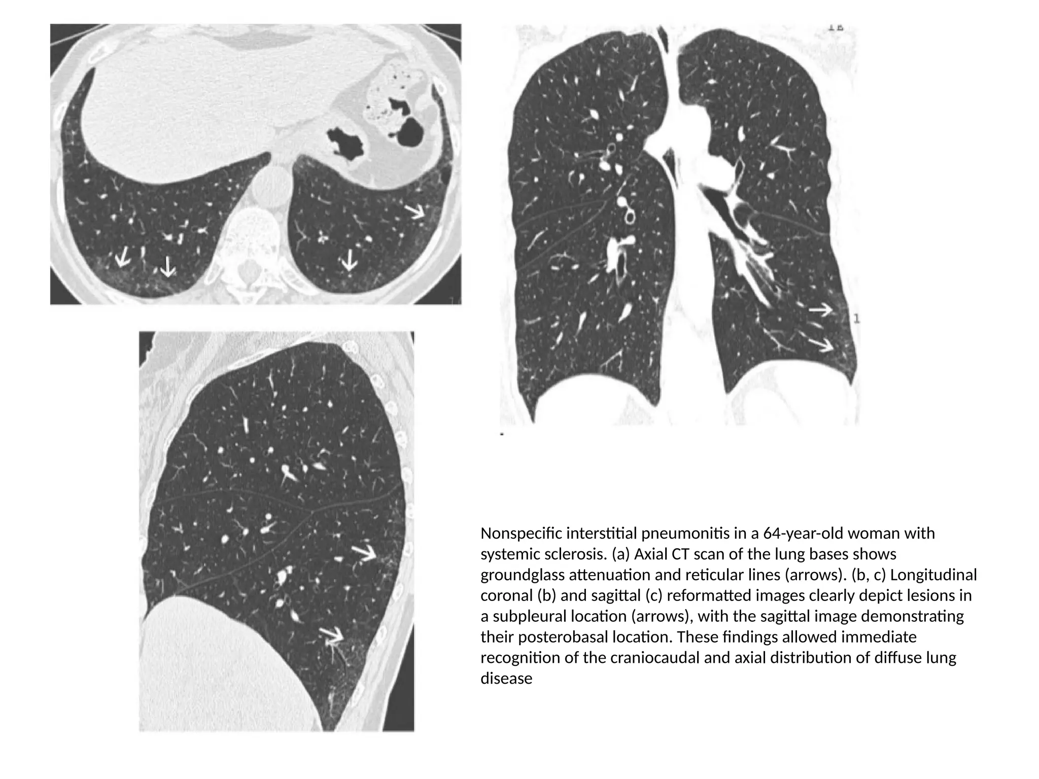 Nonspecific interstitial pneumonitis in a 64-year-old woman with
systemic sclerosis. (a) Axial CT scan of the lung bases shows
groundglass attenuation and reticular lines (arrows). (b, c) Longitudinal
coronal (b) and sagittal (c) reformatted images clearly depict lesions in
a subpleural location (arrows), with the sagittal image demonstrating
their posterobasal location. These findings allowed immediate
recognition of the craniocaudal and axial distribution of diffuse lung
disease
 