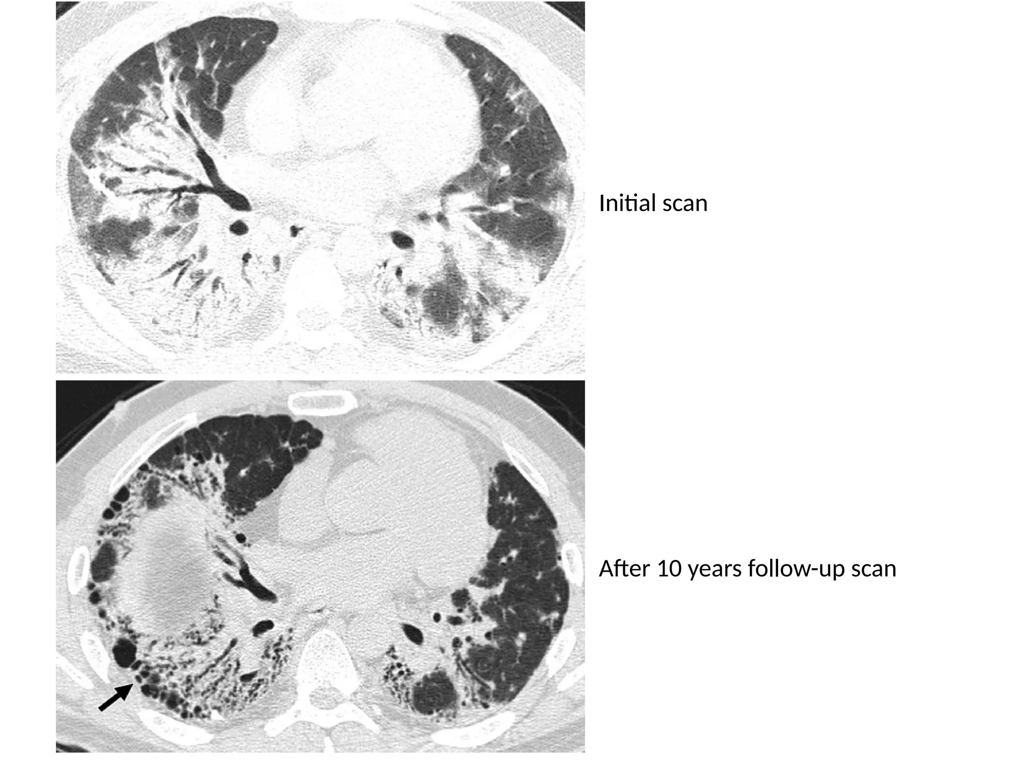 Initial scan
After 10 years follow-up scan
 
