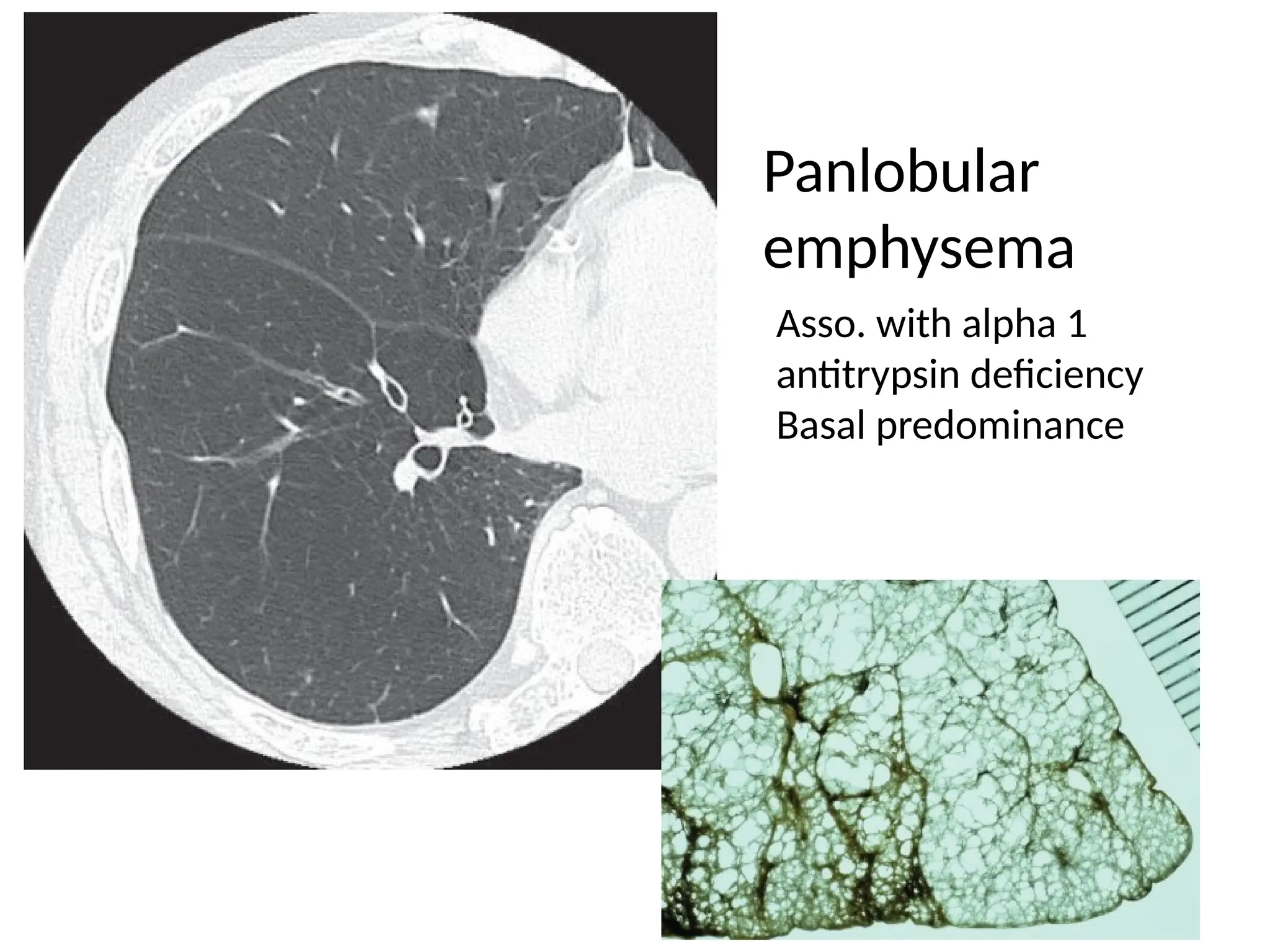 Panlobular
emphysema
Asso. with alpha 1
antitrypsin deficiency
Basal predominance
 