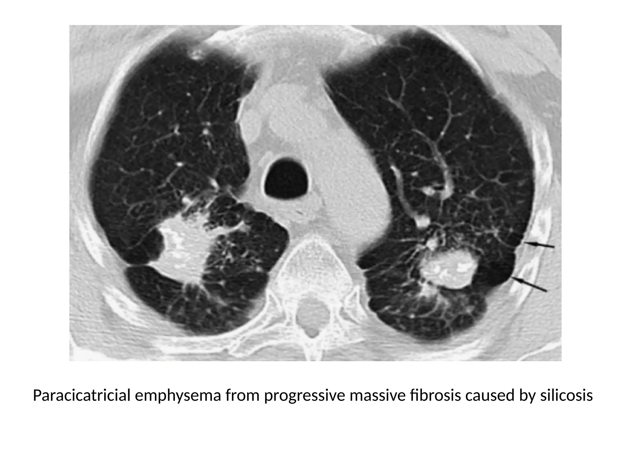 Paracicatricial emphysema from progressive massive fibrosis caused by silicosis
 