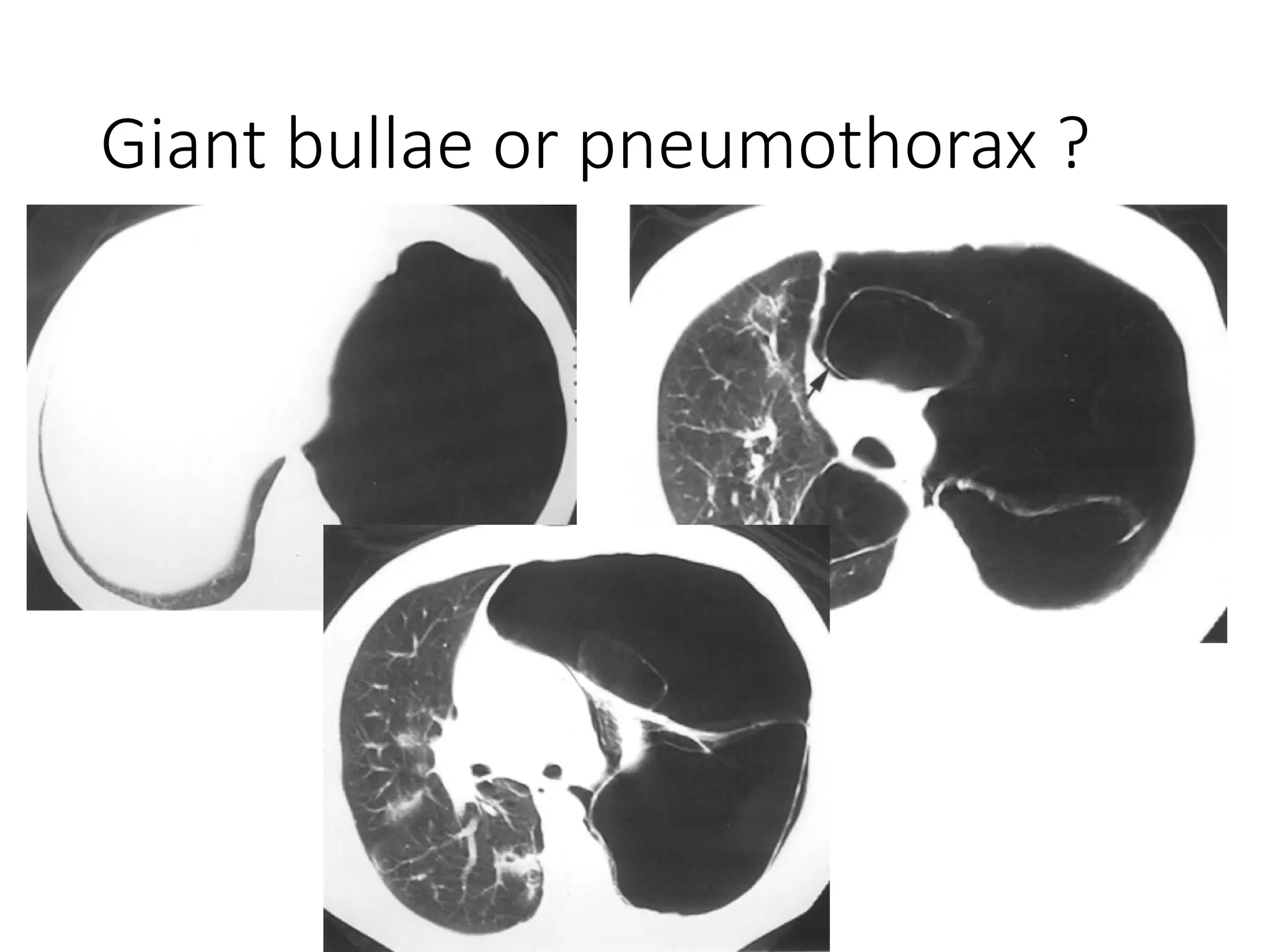 Giant bullae or pneumothorax ?
 