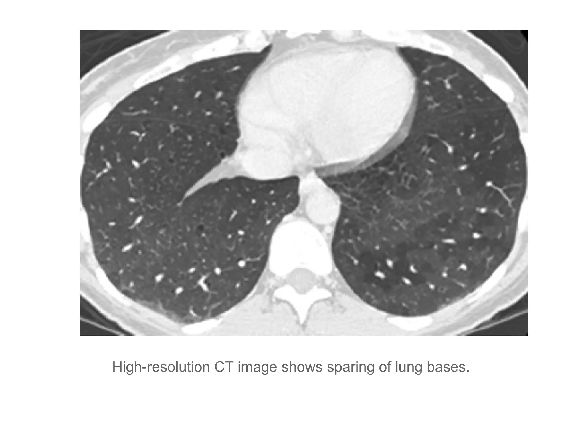 High-resolution CT image shows sparing of lung bases.
 