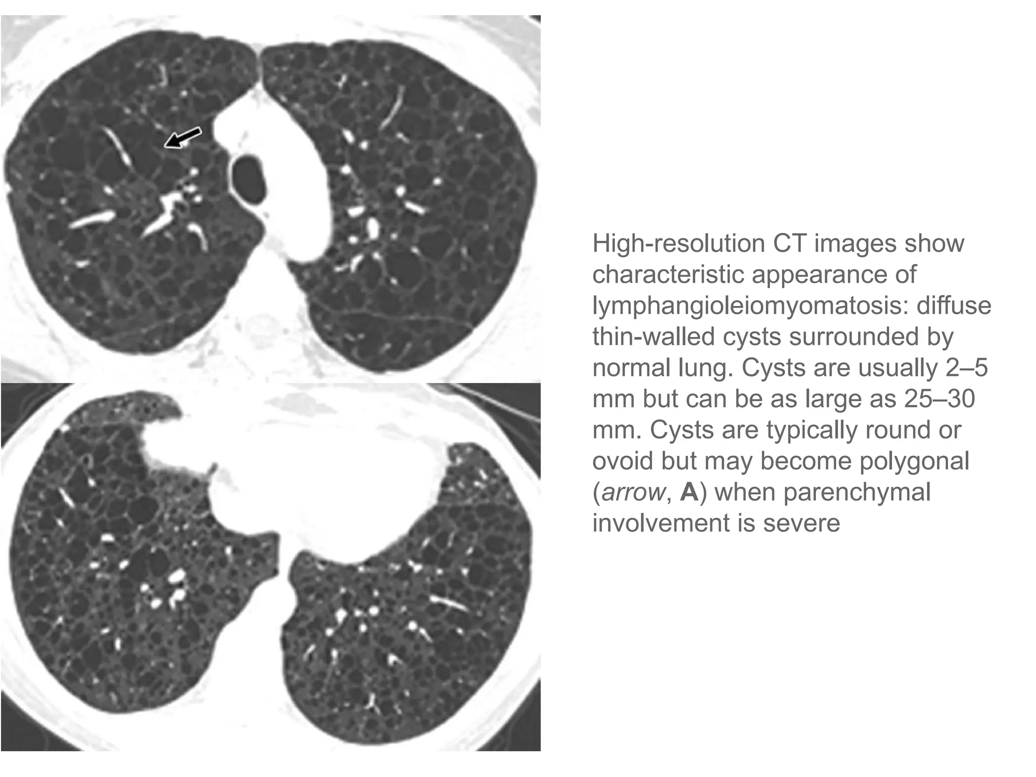 High-resolution CT images show
characteristic appearance of
lymphangioleiomyomatosis: diffuse
thin-walled cysts surrounded by
normal lung. Cysts are usually 2–5
mm but can be as large as 25–30
mm. Cysts are typically round or
ovoid but may become polygonal
(arrow, A) when parenchymal
involvement is severe
 
