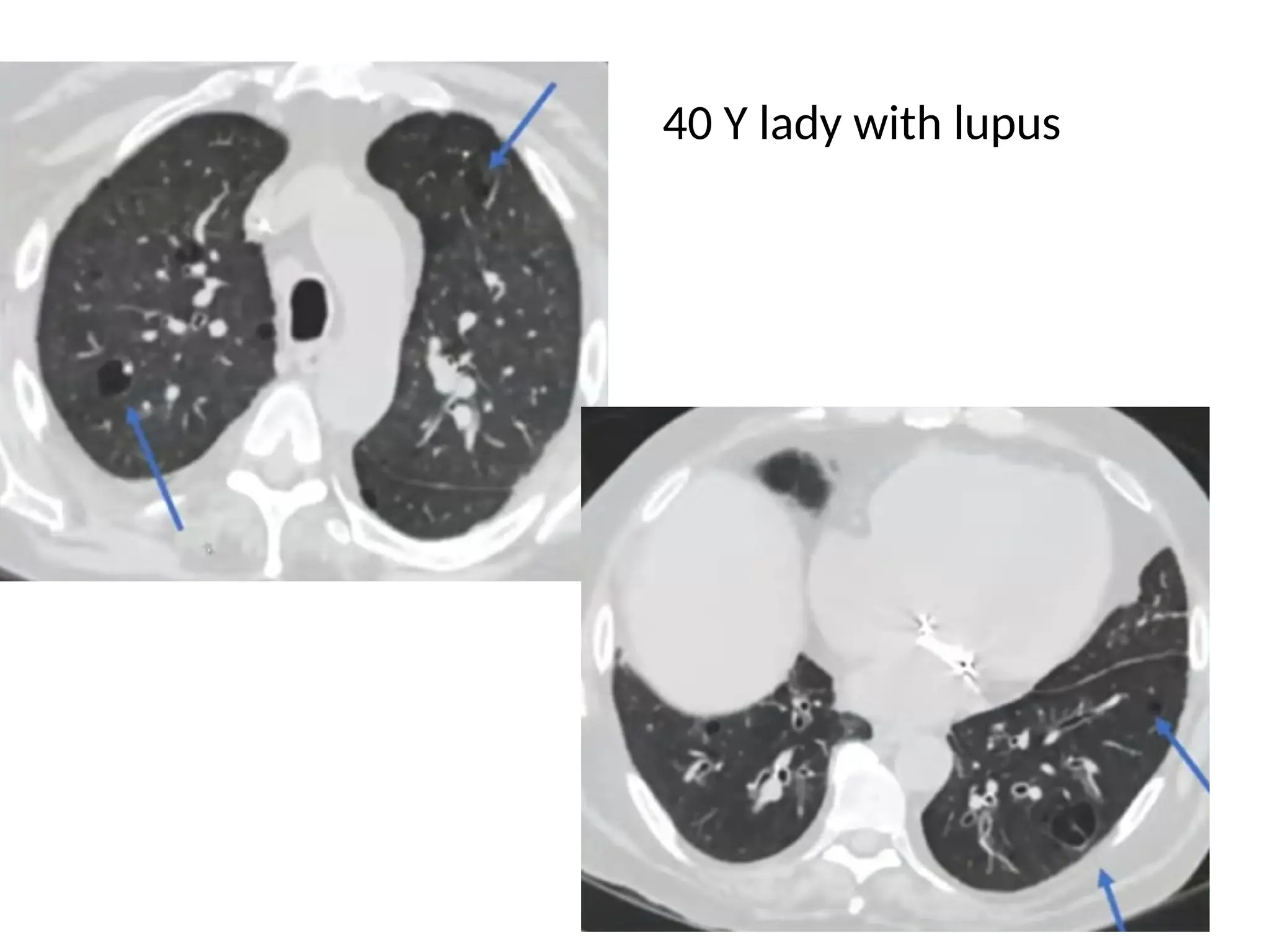 40 Y lady with lupus
 