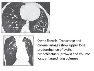 HRCT patterns in interstitial lung disease | PPTX