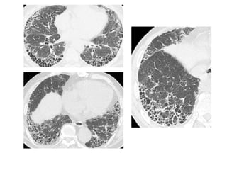 HRCT patterns in interstitial lung disease | PPTX