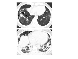 HRCT patterns in interstitial lung disease | PPTX