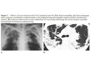 HRCT patterns in interstitial lung disease | PPTX