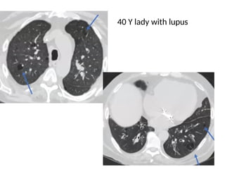 HRCT patterns in interstitial lung disease | PPTX