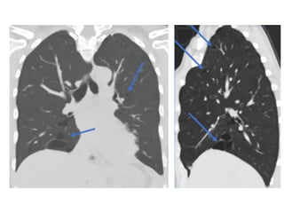 HRCT patterns in interstitial lung disease | PPTX