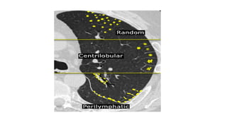 High resolution computed tomography radiology | PPTX