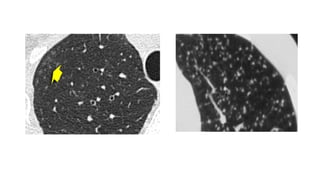 High resolution computed tomography radiology | PPTX