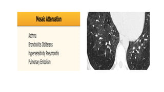 High resolution computed tomography radiology | PPTX