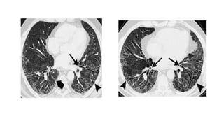 High resolution computed tomography radiology | PPTX