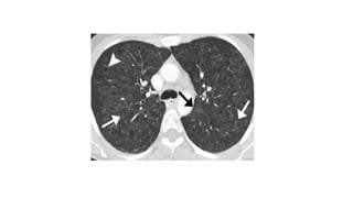 High resolution computed tomography radiology | PPTX