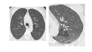 High resolution computed tomography radiology | PPTX