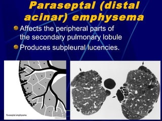 Peripharl Pattern HRCT Low attenuation pattern | PPT