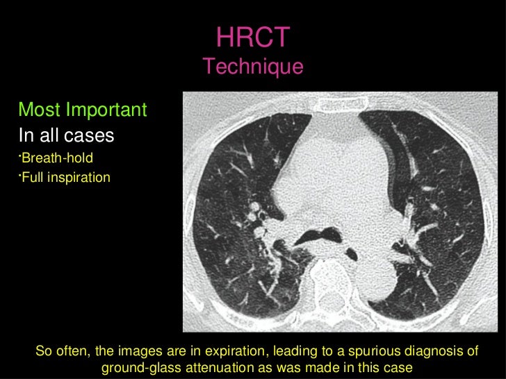 hrct