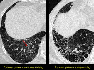 HRCT in Diffuse Lung Diseases - II (Honeycombing, UIP pattern, IPF) | PPT