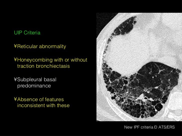 Uip Radiographic HRCT in Diffuse Lung Diseases - II (Honeycombing, UIP pattern, IPF)