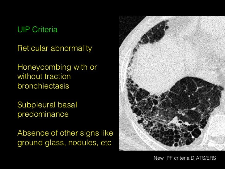 Hrct in diffuse lung diseases ii honeycombing uip pattern ipf 