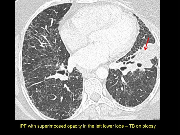 Hrct in diffuse lung diseases ii honeycombing uip pattern ipf 
