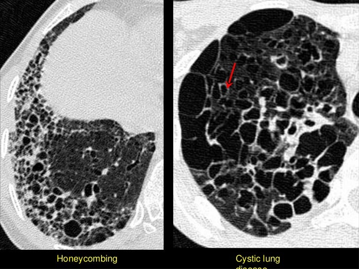 HRCT In Diffuse Lung Diseases II Honeycombing UIP Pattern IPF Delectable Uip Pattern HRCT In Diffuse Lung Diseases II Honeycombing UIP Pattern IPF Delectable Uip Pattern