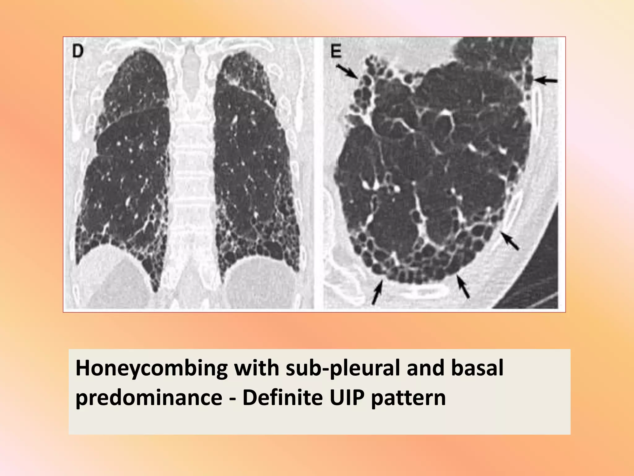 Honeycombing with sub-pleural and basal
predominance - Definite UIP pattern
 