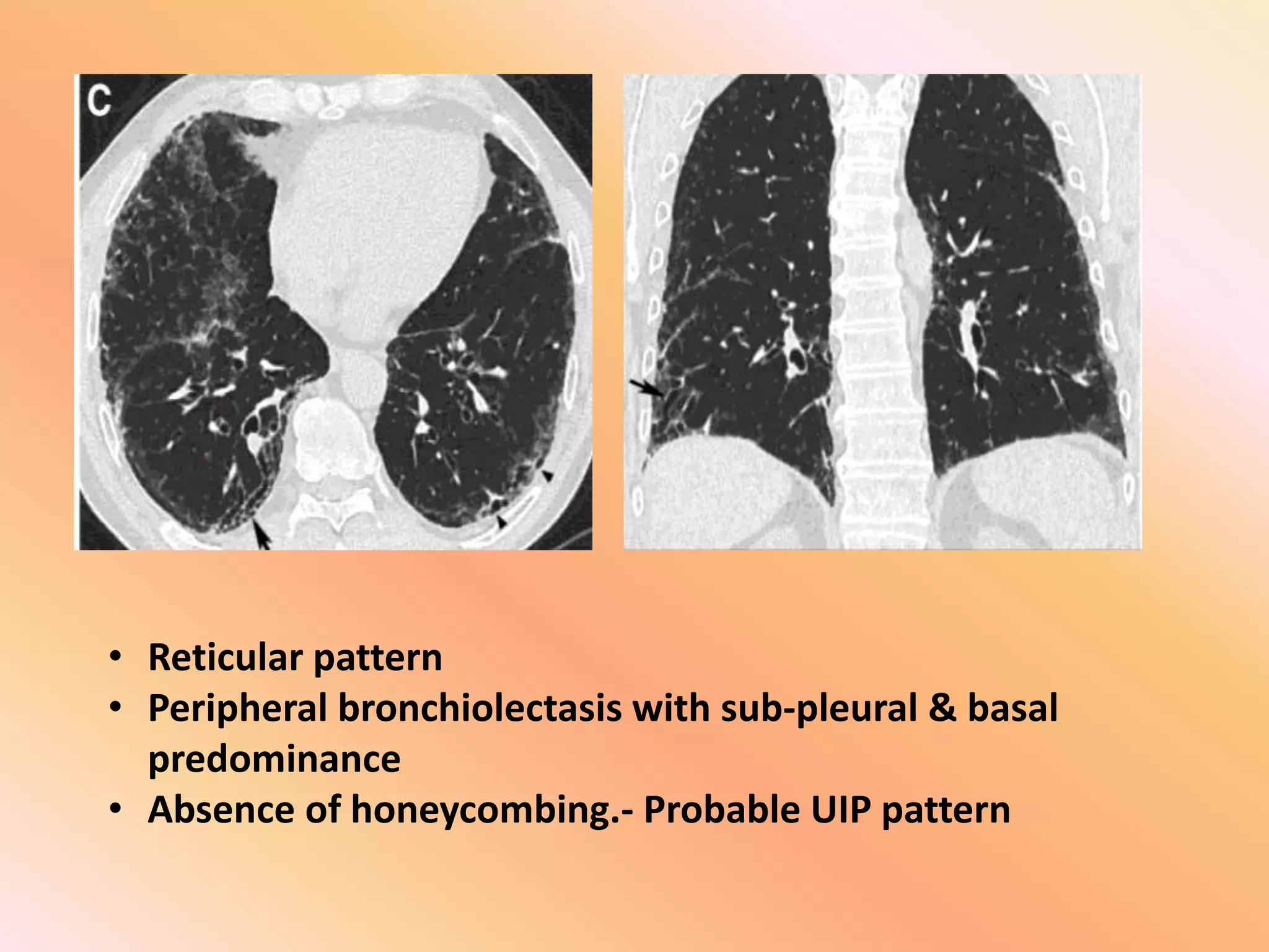 • Reticular pattern
• Peripheral bronchiolectasis with sub-pleural & basal
predominance
• Absence of honeycombing.- Probable UIP pattern
 