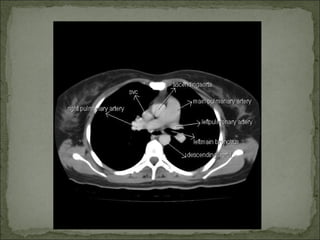 Hrct anatomy | PPT