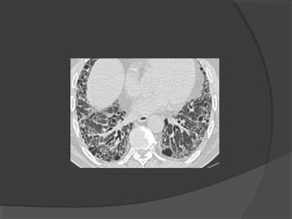 Hrct chest technique and interpretation | PPT