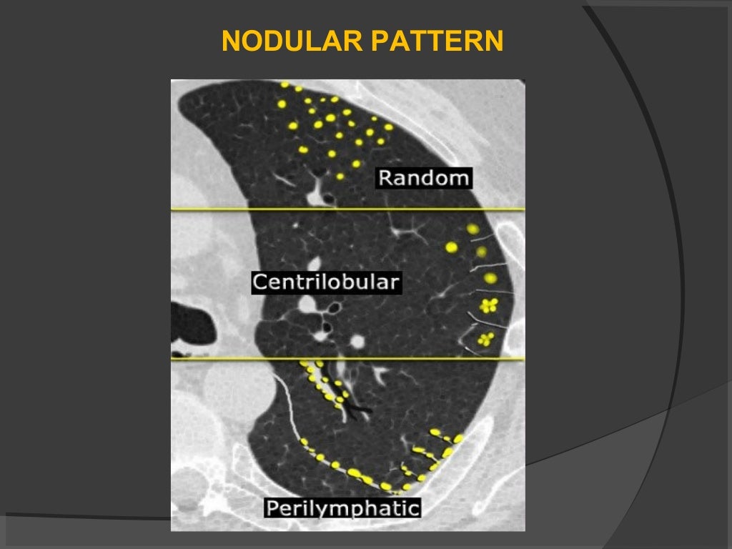 Hrct chest technique and interpretation