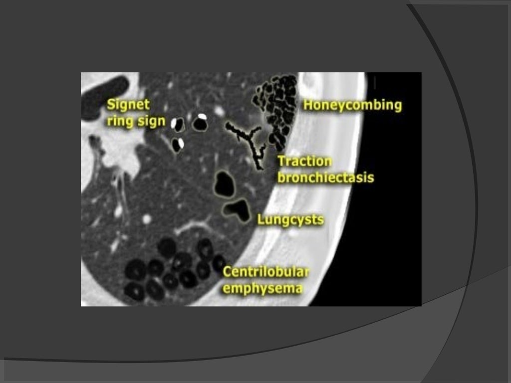 Hrct chest technique and interpretation
