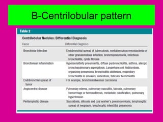 B-Centrilobular pattern
 