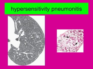 hypersensitivity pneumonitis
 