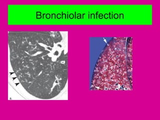 Bronchiolar infection
 