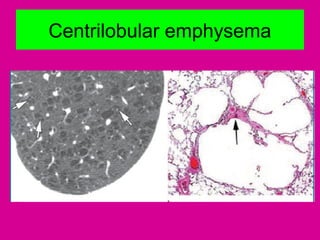 Centrilobular emphysema
 